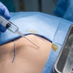 Infiltracja czy blokada nerwu po endoprotezie biodra? Wyniki badania z Yale przynoszą zaskoczenie